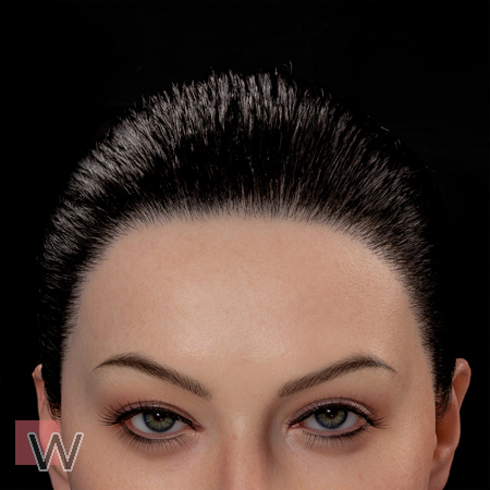 Implantiertes synthetisches Haar