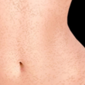 Sommersprossen am Körper (+480,00 €)